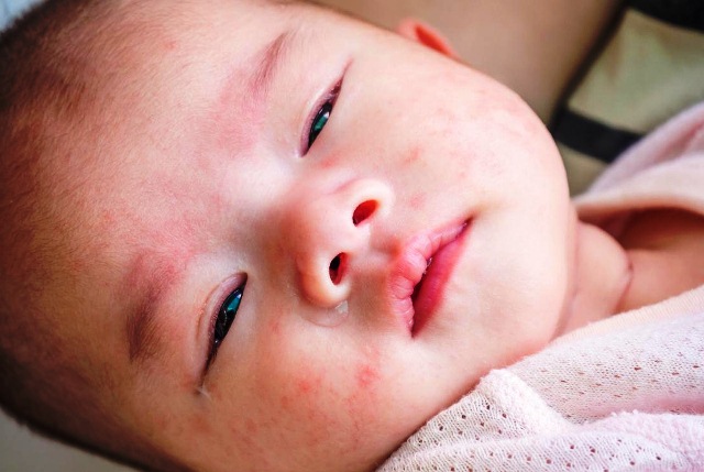 Beberapa Alergi kulit Yang Umum Dialami Oleh Bayi